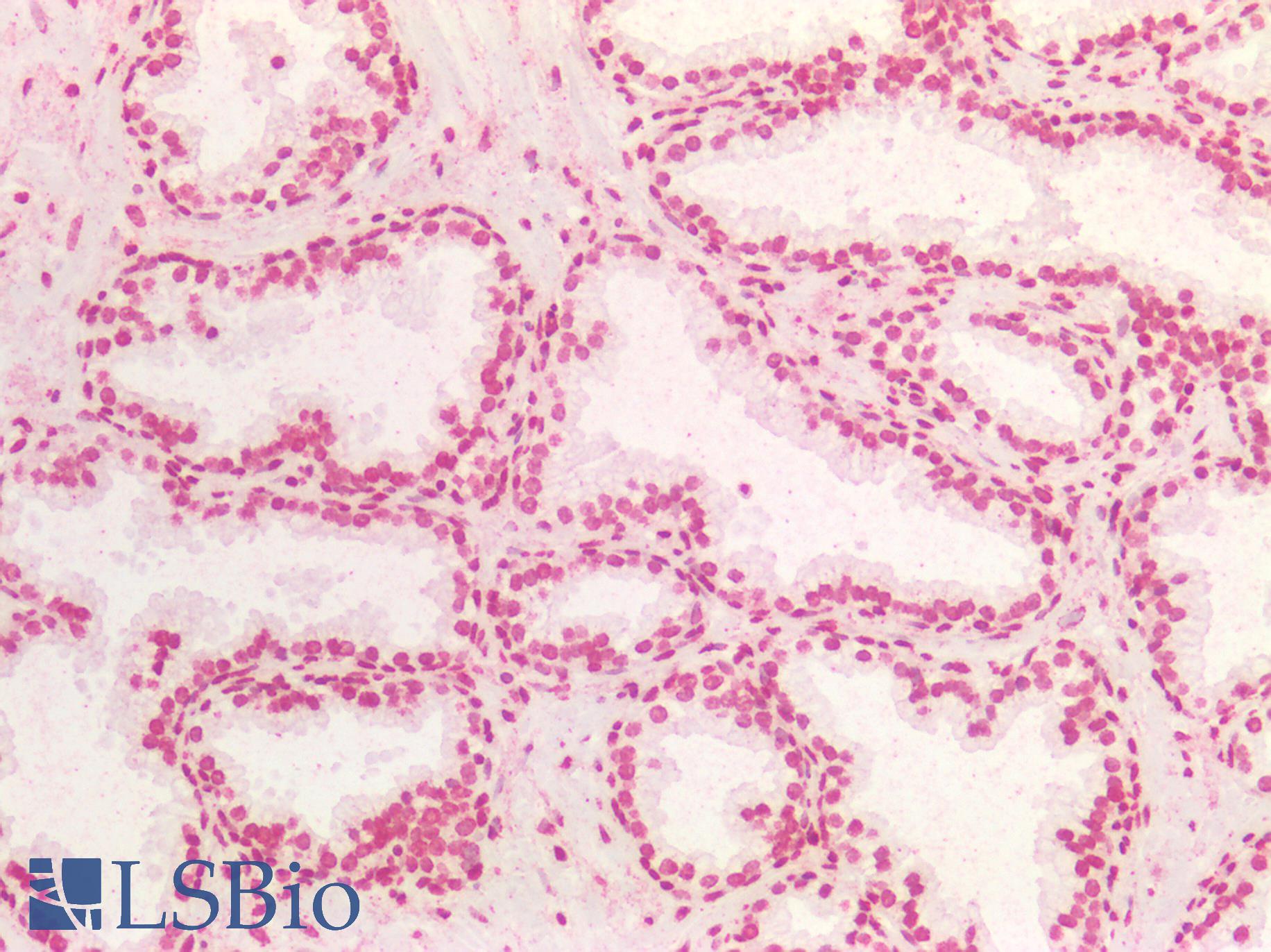 BRCA1 Antibody - Human Prostate: Formalin-Fixed, Paraffin-Embedded (FFPE)