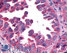 CALCRL / CGRP Receptor Antibody - Anti-CALCRL  / CGRP Receptor antibody IHC of human Lung, Non-Small Cell Carcinoma. Immunohistochemistry of formalin-fixed, paraffin-embedded tissue after heat-induced antigen retrieval.