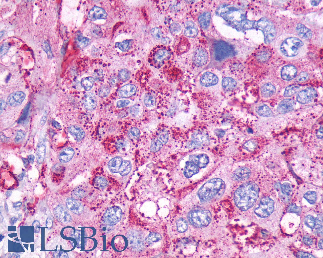 CCKBR / Cckb Antibody - Anti-CCKBR / Cckb antibody IHC of human Pancreas, Carcinoma. Immunohistochemistry of formalin-fixed, paraffin-embedded tissue after heat-induced antigen retrieval.