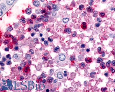CCR1 Antibody - Colon Ulcerative colitis eosinophils