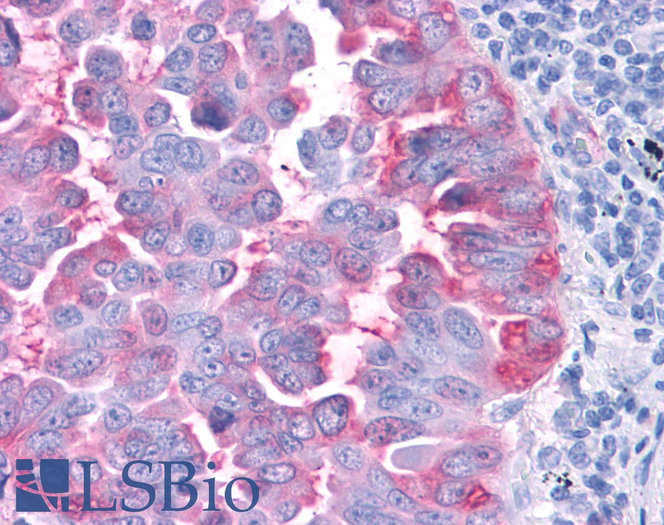 CCR4 Antibody - Anti-CCR4 antibody IHC of human Lung, Non-Small Cell Carcinoma. Immunohistochemistry of formalin-fixed, paraffin-embedded tissue after heat-induced antigen retrieval.