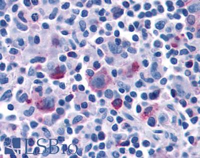 CCR7 Antibody - Hodgkin's disease Reed Sternberg cells