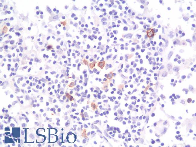 CD30 Antibody - Human Thyroid: Formalin-Fixed, Paraffin-Embedded (FFPE)