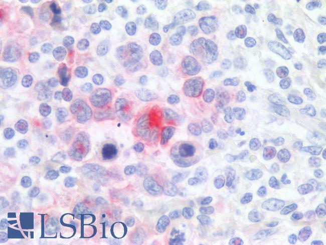 CD30 Antibody - Human Lymph Node, Reed Sternberg Cell: Formalin-Fixed, Paraffin-Embedded (FFPE)