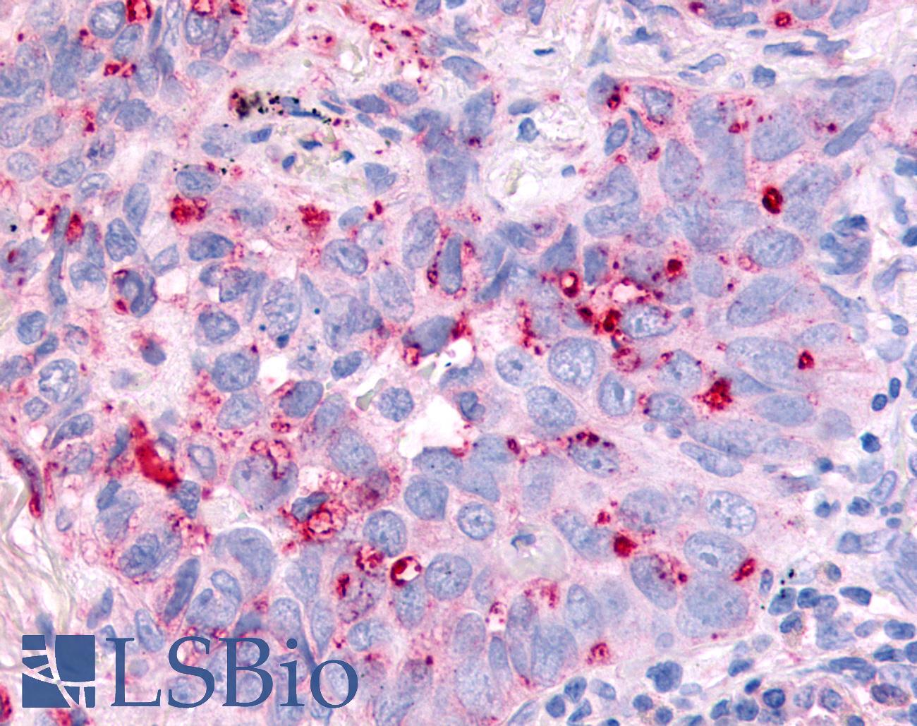 CDC7 Antibody - Anti-CDC7 antibody IHC of human Lung, Non-Small Cell Carcinoma. Immunohistochemistry of formalin-fixed, paraffin-embedded tissue after heat-induced antigen retrieval.
