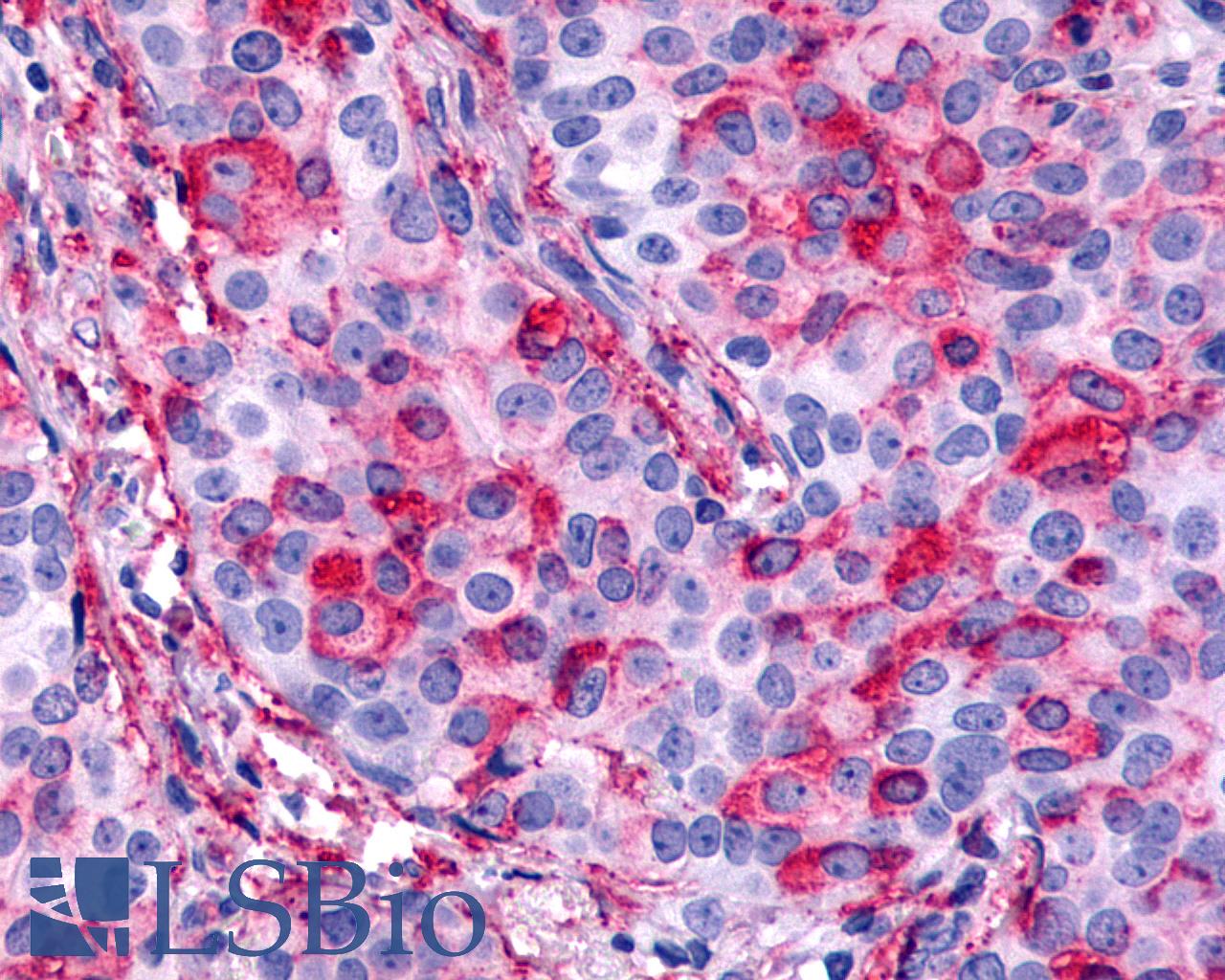CELSR1 Antibody - Breast, Carcinoma