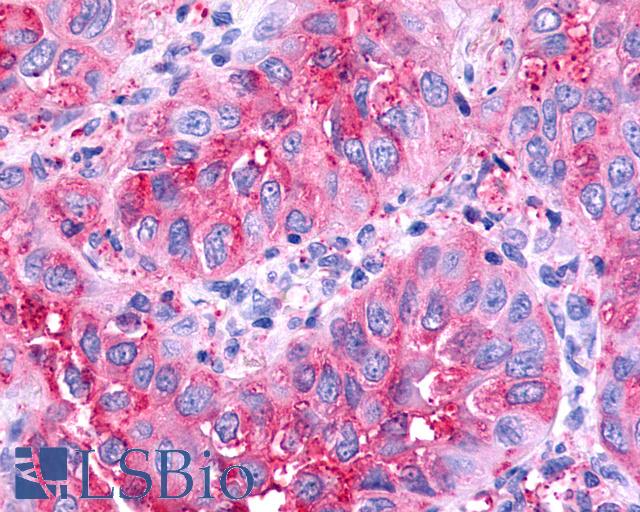 CELSR1 Antibody - Anti-CELSR1 antibody IHC of human Lung, Non-Small Cell Carcinoma. Immunohistochemistry of formalin-fixed, paraffin-embedded tissue after heat-induced antigen retrieval.