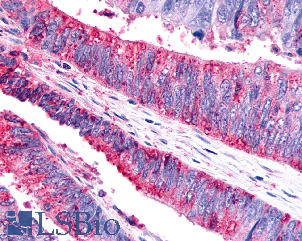 CELSR1 Antibody - Colon, Carcinoma
