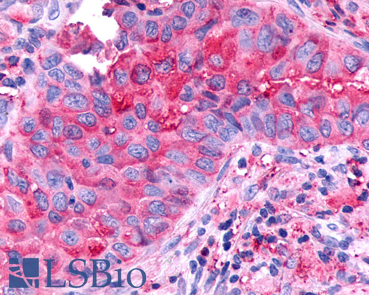 CELSR1 Antibody - Lung, Non Small-Cell Carcinoma