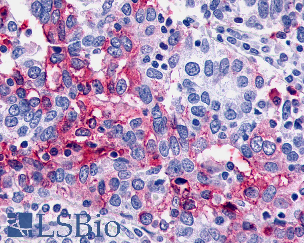 CELSR1 Antibody - Ovary, carcinoma