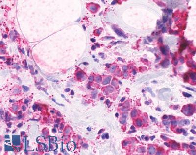 CELSR2 Antibody - Breast, adenocarcinoma