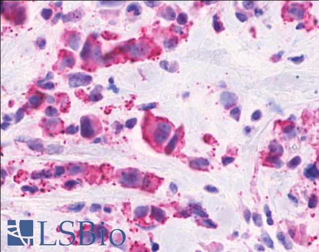 CELSR2 Antibody - Anti-CELSR2 antibody IHC of human Breast, Carcinoma. Immunohistochemistry of formalin-fixed, paraffin-embedded tissue after heat-induced antigen retrieval.