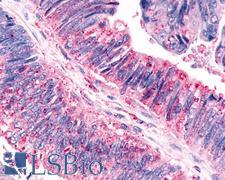 CELSR3 Antibody - Anti-CELSR3 antibody IHC of human Colon, Carcinoma. Immunohistochemistry of formalin-fixed, paraffin-embedded tissue after heat-induced antigen retrieval.