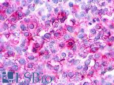 CHEMR23 / CMKLR1 Antibody - Ovary, Carcinoma