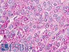 CHEMR23 / CMKLR1 Antibody - Ovary, Carcinoma
