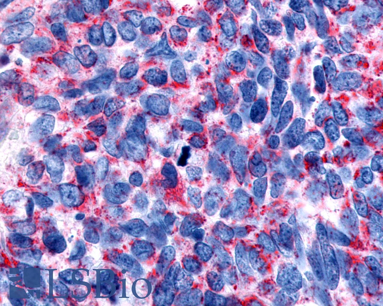 CHRM2 / M2 Antibody - Anti-CHRM2 / M2 antibody IHC of human Lung, Small Cell Carcinoma. Immunohistochemistry of formalin-fixed, paraffin-embedded tissue after heat-induced antigen retrieval.