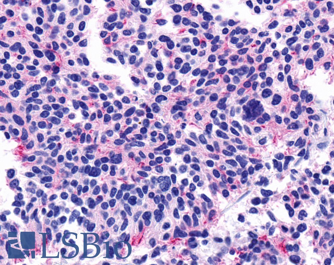 CHRM5 / M5 Antibody - Anti-CHRM5 / M5 antibody IHC of human Lung, Small Cell Carcinoma. Immunohistochemistry of formalin-fixed, paraffin-embedded tissue after heat-induced antigen retrieval.
