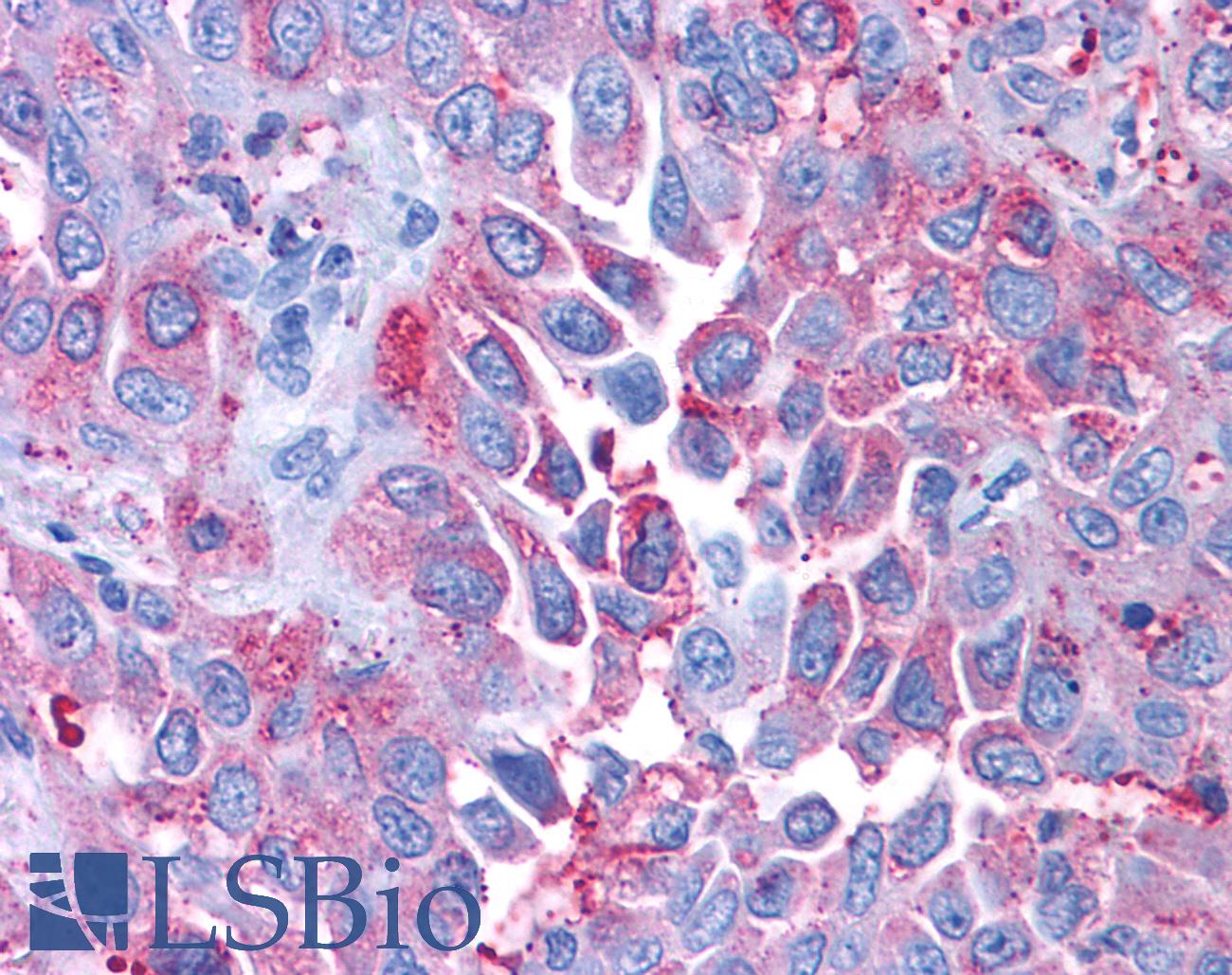 CRFR1 / CRHR1 Antibody - Anti-CRFR1 / CRHR1 antibody IHC of human Lung, Non-Small Cell Carcinoma. Immunohistochemistry of formalin-fixed, paraffin-embedded tissue after heat-induced antigen retrieval.