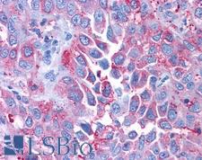 CRFR1 / CRHR1 Antibody - Anti-CRFR1 / CRHR1 antibody IHC of human Lung, Non-Small Cell Carcinoma. Immunohistochemistry of formalin-fixed, paraffin-embedded tissue after heat-induced antigen retrieval.
