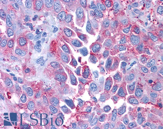 CRFR1 / CRHR1 Antibody - Anti-CRFR1 / CRHR1 antibody IHC of human Lung, Non-Small Cell Carcinoma. Immunohistochemistry of formalin-fixed, paraffin-embedded tissue after heat-induced antigen retrieval.