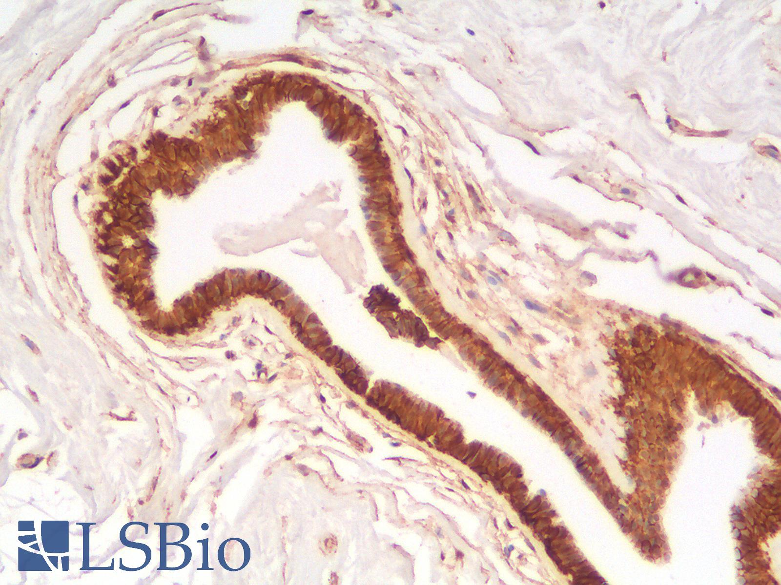 CTNNB1 / Beta Catenin Antibody - Human Breast: Formalin-Fixed, Paraffin-Embedded (FFPE)