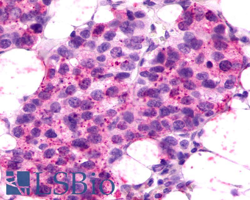 CXCR2 Antibody - Breast, Carcinoma