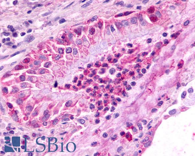 CXCR2 Antibody - Lung, Non Small-Cell Carcinoma
