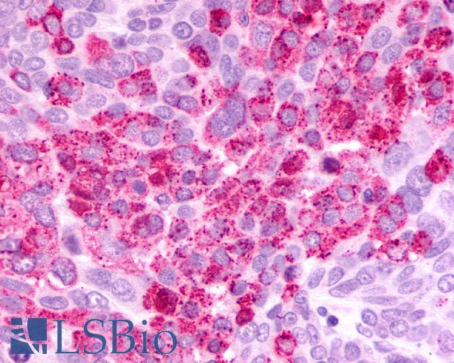 CXCR2 Antibody - Ovary, Carcinoma