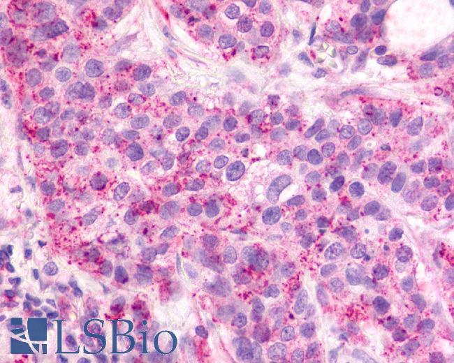 CXCR2 Antibody - Breast, Carcinoma