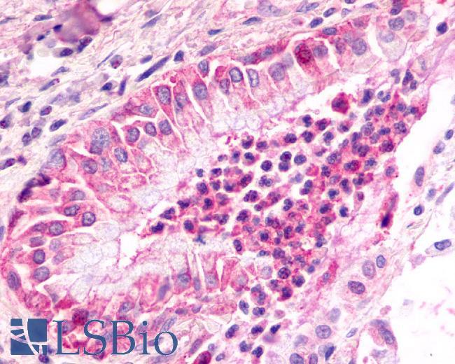 CXCR2 Antibody - Lung, Non Small-Cell Carcinoma