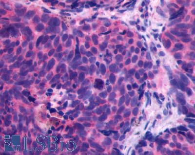 CXCR4 Antibody - Lung, small cell carcinoma