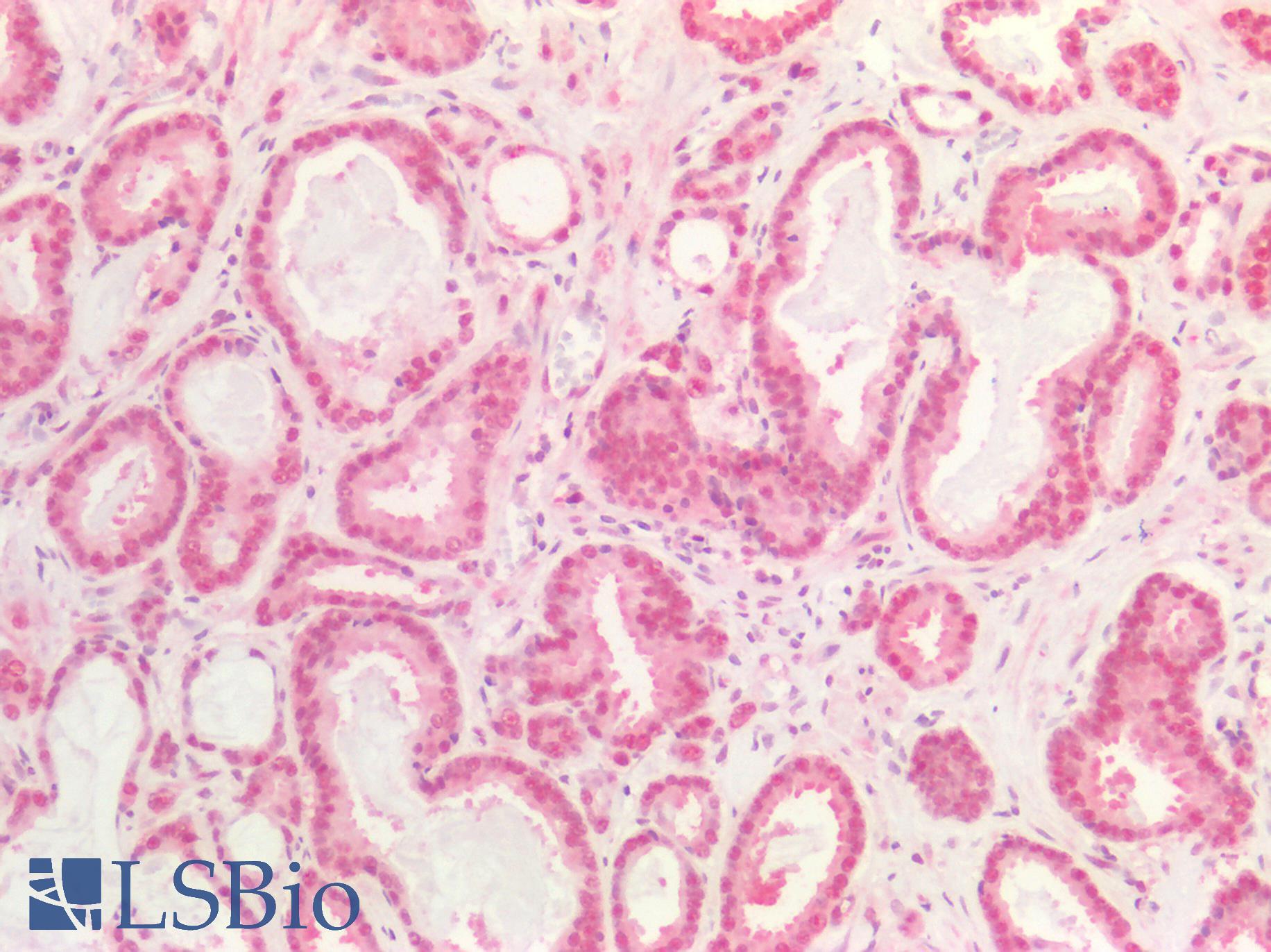 DNMT / DNMT1 Antibody - Human Prostate Carcinoma: Formalin-Fixed, Paraffin-Embedded (FFPE)