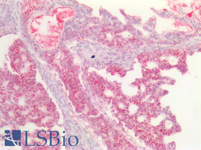 DNMT / DNMT1 Antibody - Human Ovary Carcinoma: Formalin-Fixed, Paraffin-Embedded (FFPE)