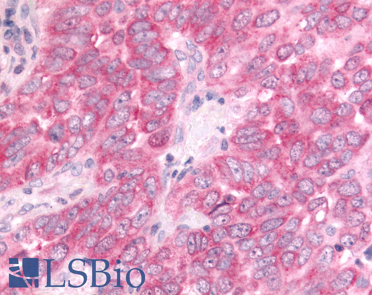 DUSP22 / JSP 1 Antibody - Anti-DUSP22 / JSP 1 antibody IHC of human Lung, Non-Small Cell Carcinoma. Immunohistochemistry of formalin-fixed, paraffin-embedded tissue after heat-induced antigen retrieval.