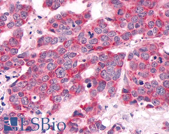 DUSP26 / MKP8 Antibody - Anti-MKP-8 / DUSP26 antibody IHC of human Lung, Small Cell Carcinoma. Immunohistochemistry of formalin-fixed, paraffin-embedded tissue after heat-induced antigen retrieval.