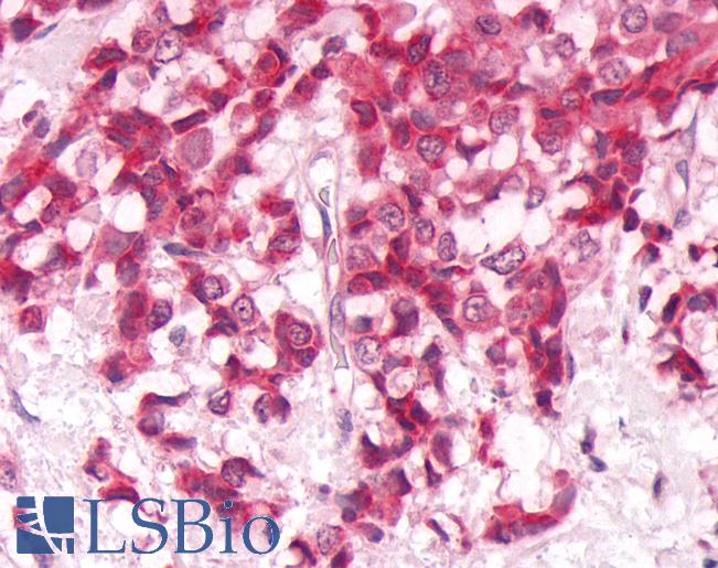 DUSP26 / MKP8 Antibody - Anti-MKP-8 / DUSP26 antibody IHC of human Breast, Carcinoma. Immunohistochemistry of formalin-fixed, paraffin-embedded tissue after heat-induced antigen retrieval.