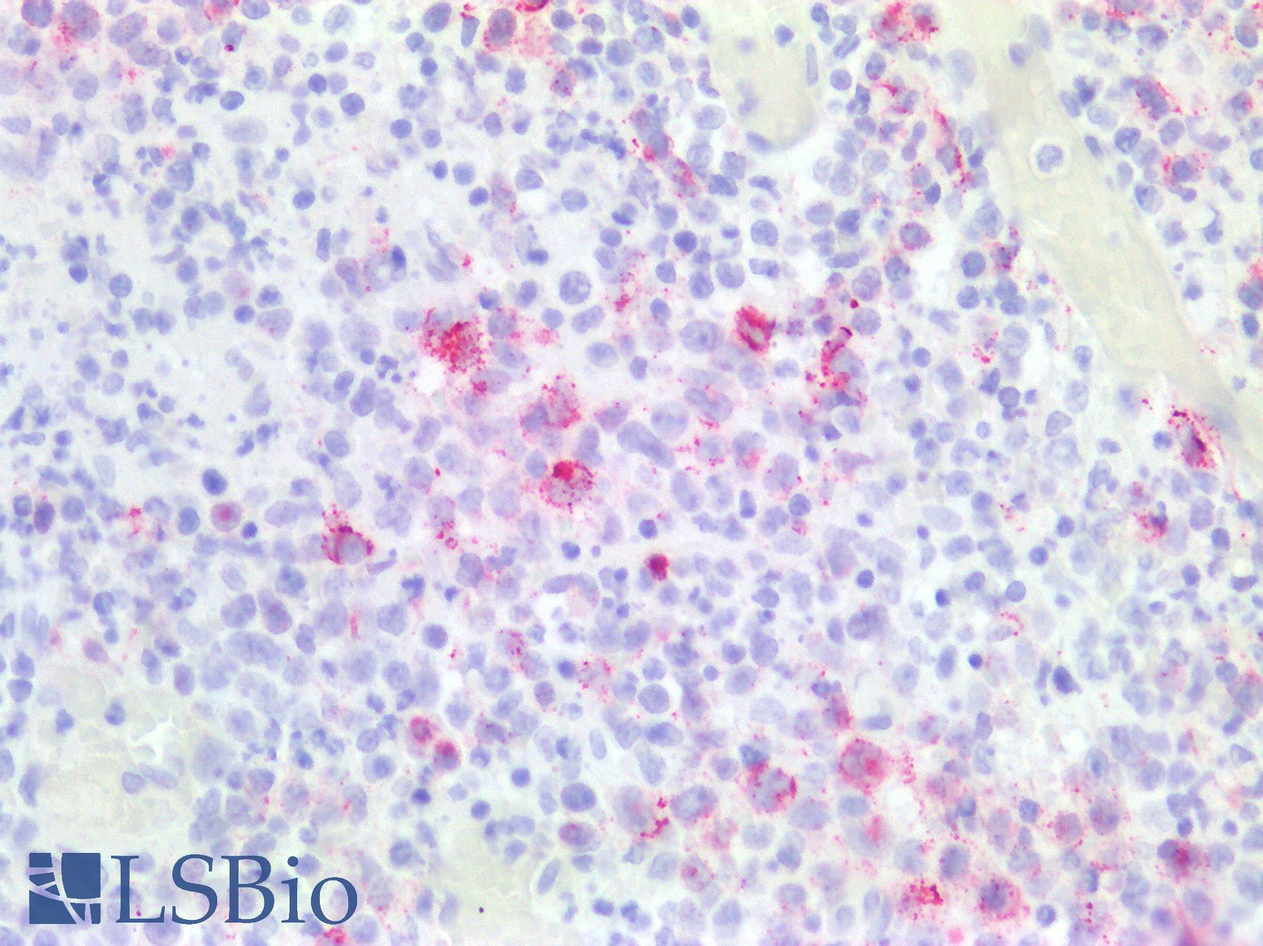 EBV LMP Antibody - Human Tonsil, Lymphocytes Infected by Epstein Barr Virus: Formalin-Fixed, Paraffin-Embedded (FFPE)