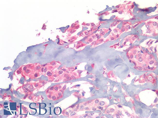 EGFR Antibody - Human Breast Carcinoma: Formalin-Fixed, Paraffin-Embedded (FFPE)