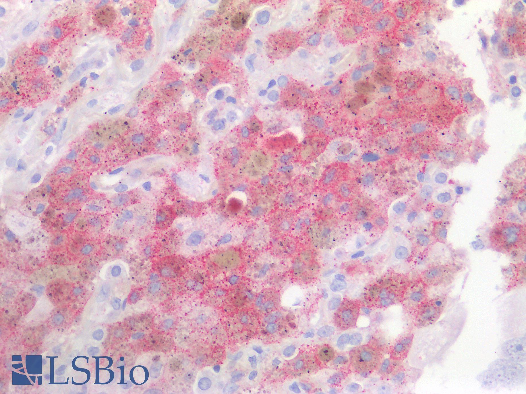 EGFR Antibody - Human Lung Carcinoma: Formalin-Fixed, Paraffin-Embedded (FFPE)