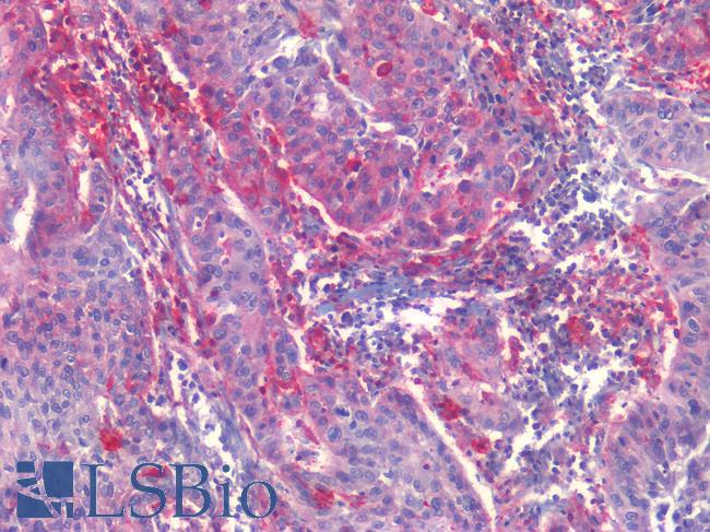EPHB2 / EPH Receptor B2 Antibody - Human Lung Carcinoma: Formalin-Fixed, Paraffin-Embedded (FFPE)
