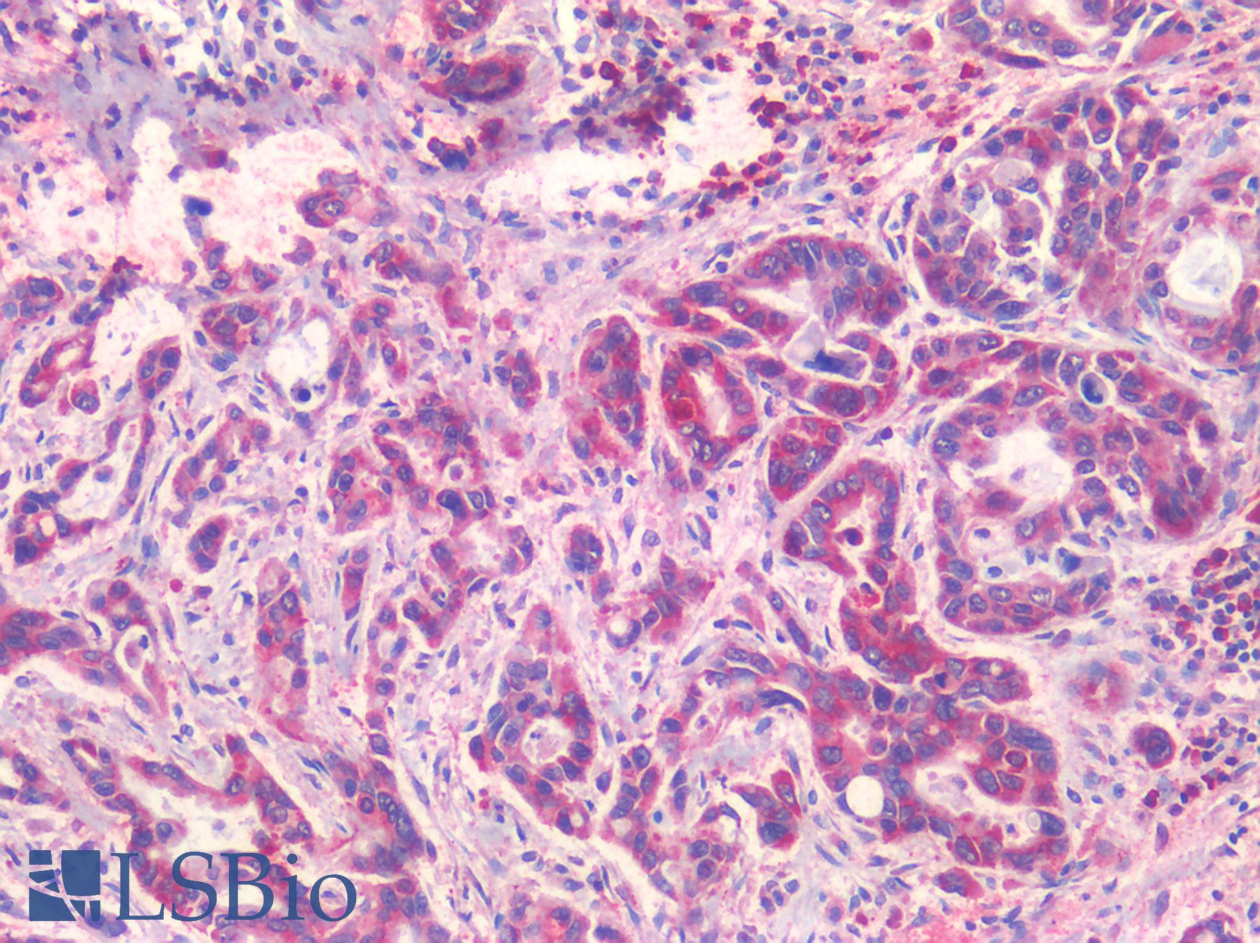 EPHB2 / EPH Receptor B2 Antibody - Human Prostate Carcinoma: Formalin-Fixed, Paraffin-Embedded (FFPE)