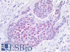 ER Alpha / Estrogen Receptor Antibody - Human Breast, Carcinoma: Formalin-Fixed, Paraffin-Embedded (FFPE)