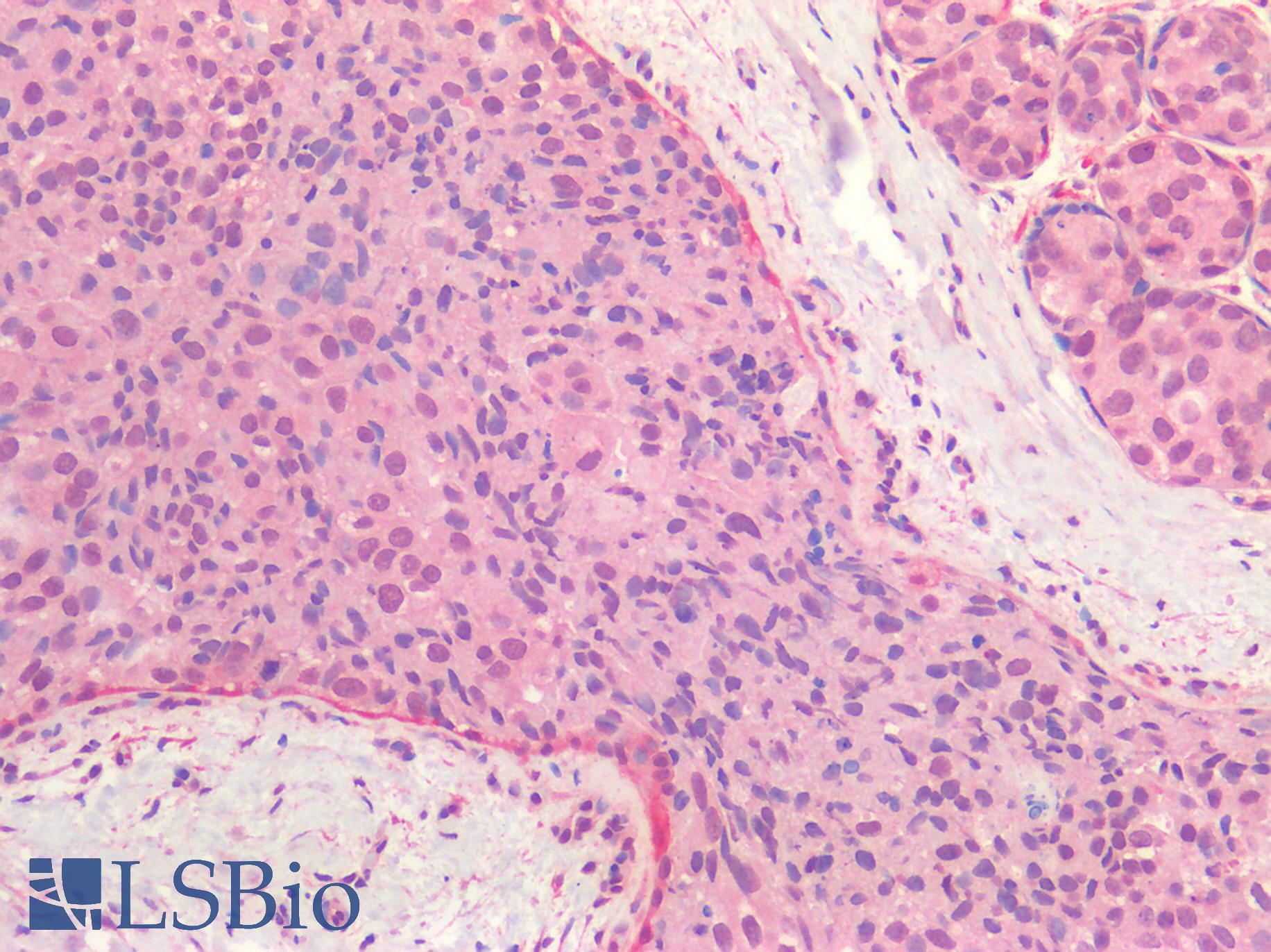 ER Alpha / Estrogen Receptor Antibody - Human Breast, Carcinoma: Formalin-Fixed, Paraffin-Embedded (FFPE)