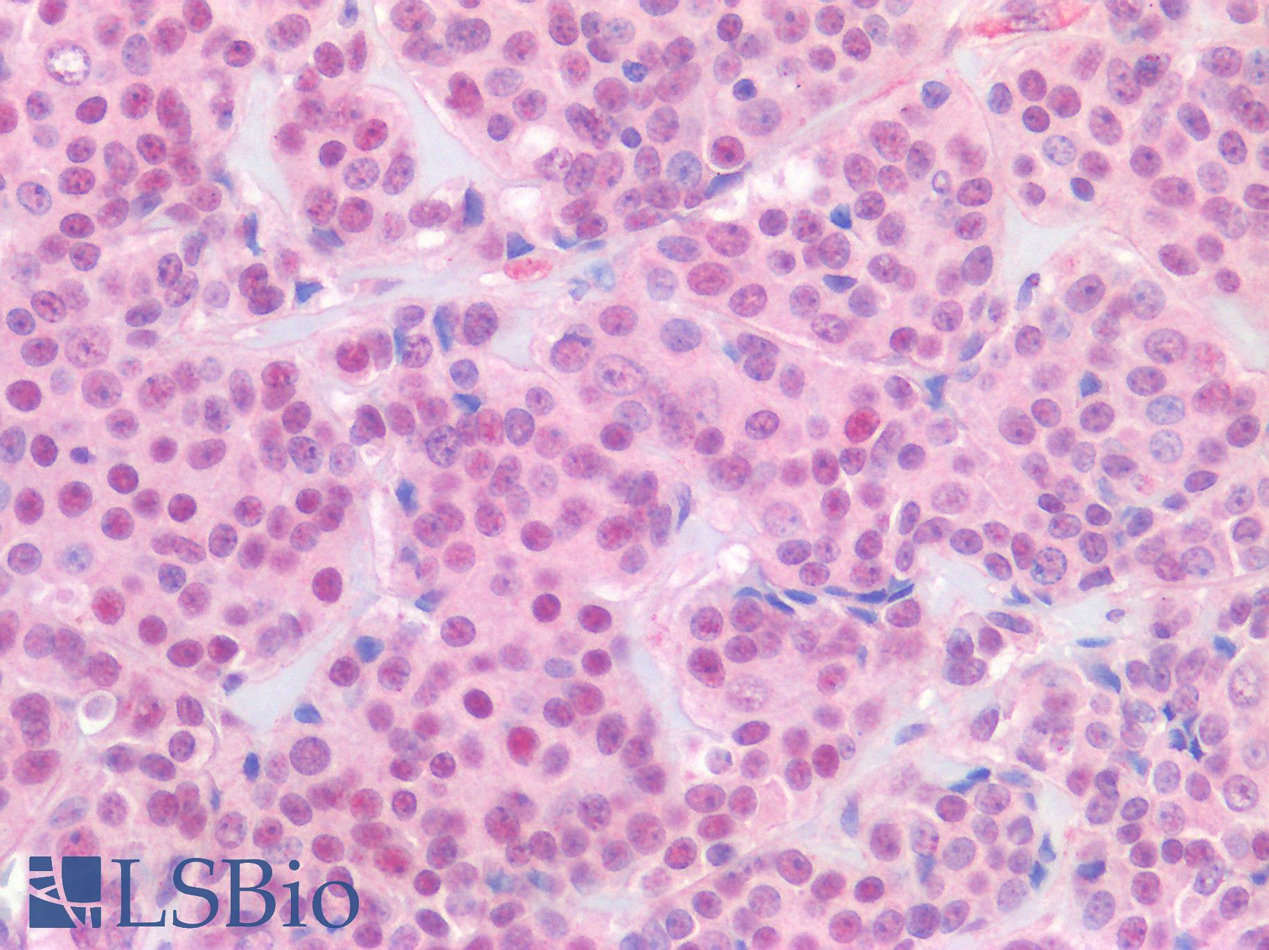 ER Alpha / Estrogen Receptor Antibody - Human Breast Carcinoma: Formalin-Fixed, Paraffin-Embedded (FFPE)