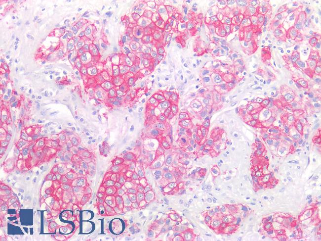 ERBB2 / HER2 Antibody - Human Breast Carcinoma: Formalin-Fixed, Paraffin-Embedded (FFPE)