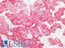 ERBB2 / HER2 Antibody - Human Breast Carcinoma: Formalin-Fixed, Paraffin-Embedded (FFPE)