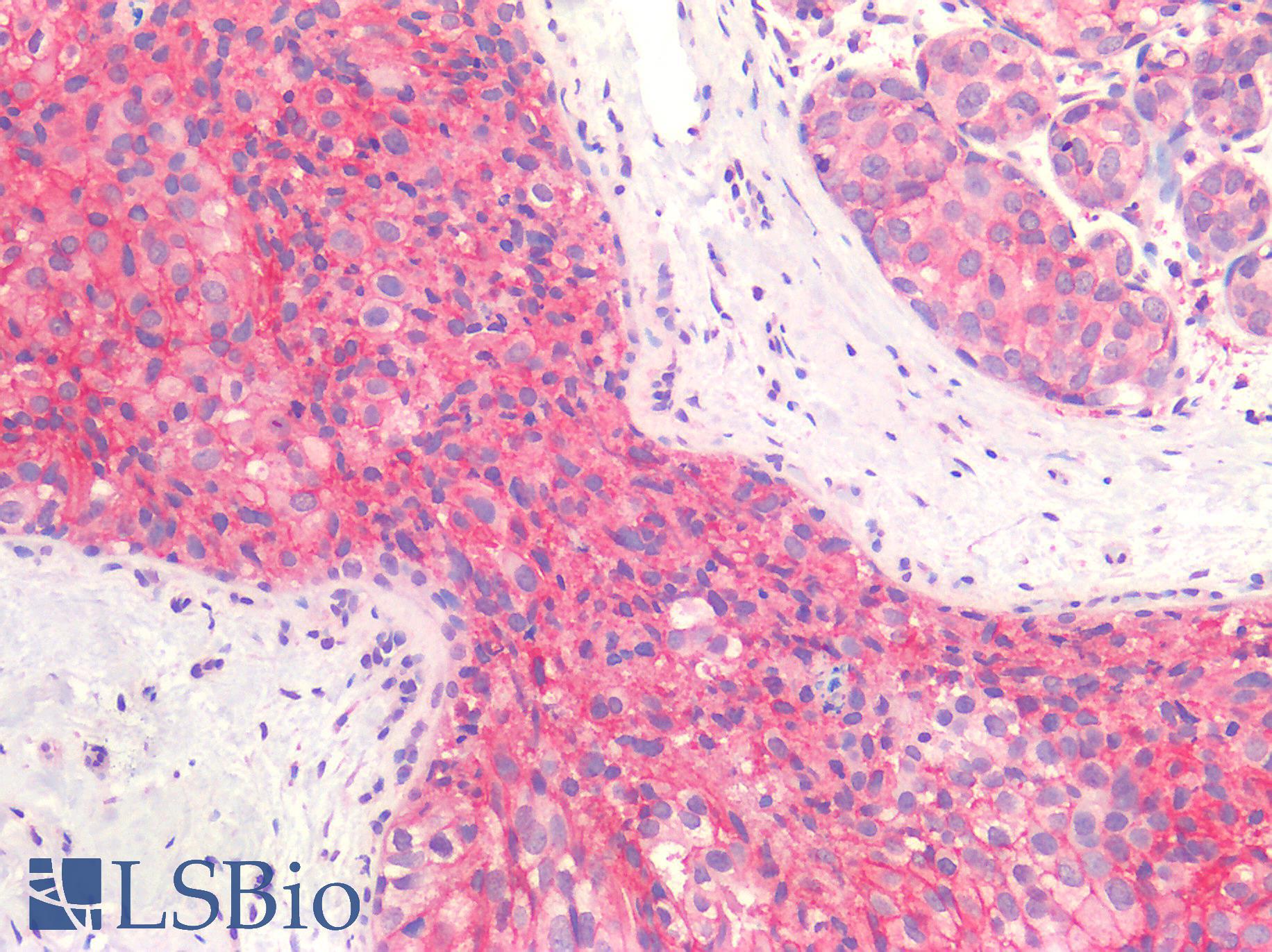 ERBB2 / HER2 Antibody - Human Breast, Carcinoma: Formalin-Fixed, Paraffin-Embedded (FFPE)