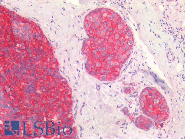 ERBB2 / HER2 Antibody - Human Breast, Carcinoma: Formalin-Fixed, Paraffin-Embedded (FFPE)