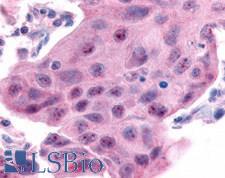 ESRRA / ERR Alpha Antibody - Anti-ESRRA antibody IHC of human breast carcinoma. Immunohistochemistry of formalin-fixed, paraffin-embedded tissue after heat-induced antigen retrieval.