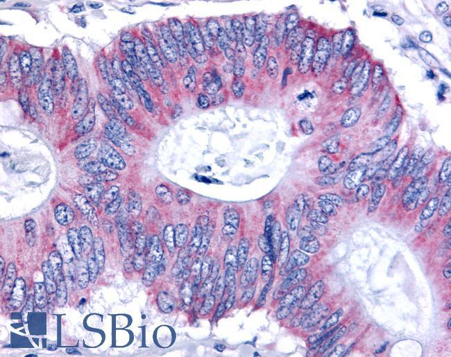 ESRRB / ERR Beta Antibody - Colon, Carcinoma